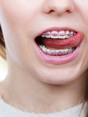 Happy woman showing her braces on teeth