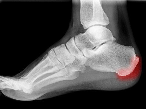 Röntgenbild Fuß mit Entzündung