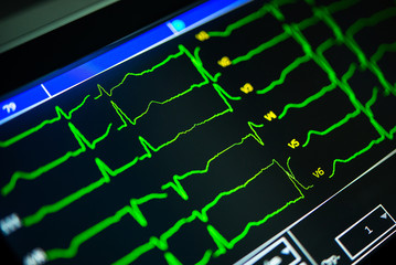 cardiogram close-up on a cardiograph monitor