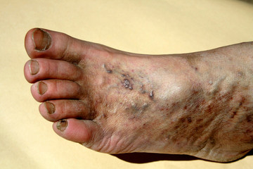Varicose veins. Thrombosis. Foot. Extension of veins on the leg.