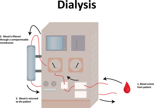 Dialysis