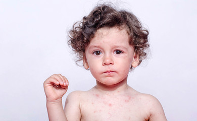 Portrait of a cute sick baby boy upset. Adorable upset child with spots on his face and body form illness, mosquito bites, roseola, rubella, measles. - 169526083