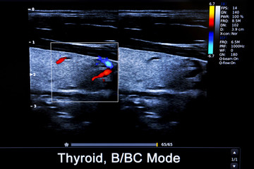 Colourful image of modern ultrasound monitor