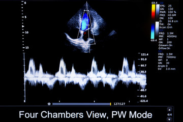 Colourful image of homan heart ultrasound monitor