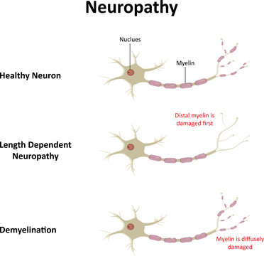 Neuropathy