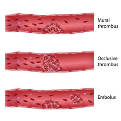 Types of thrombosis  - obrazy, fototapety, plakaty