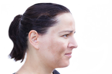 Junge Frau mit Pigmentflecken auf den Wangen auf weißem Hintergrund 