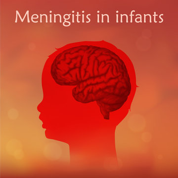 Meningitis In Infants. Vector Medical Illustration. Kid, Baby, Childhood. Blurred Orange Background, Red Silhouette Of Child Head, Anatomy Image Of Brain.