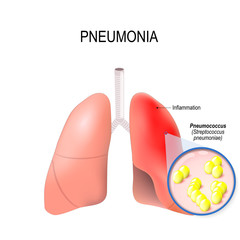 Pneumonia. Normal and inflammatory condition of the lung.