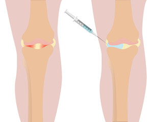 Knee injection inflamation redness vector illustration