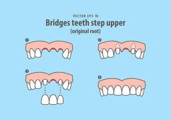 Bridges teeth step upper (original root) illustration vector on blue background. Dental concept.