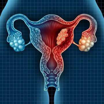 Uterus Cancer