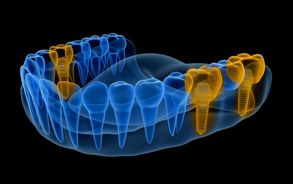 X-ray view of denture with implants .  Xray view. Medically accurate 3D illustration