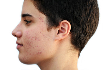 Obraz premium Teenager with Acne/ Adolescente con acné
