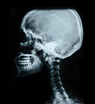 Human skull X-ray image.