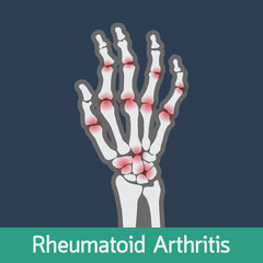 Rheumatoid Arthritis vector icon illustration