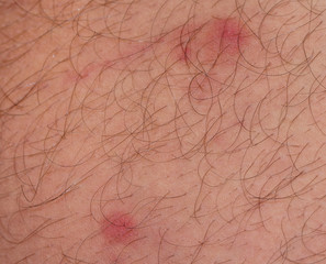 closeup of redness over caucasian skin