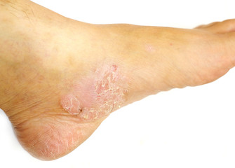 Psoriasis on white isolated
