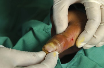 Infection accident thumb.