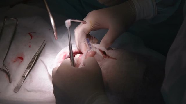the surgeon makes a difficult dental surgery. Dentures
