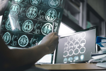 alzheimer's disease on MRI