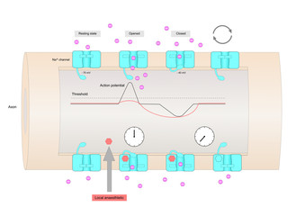 Mechanism of action of a local anesthetic (or anaesthetic), inhibiting voltage-gated sodium channels.