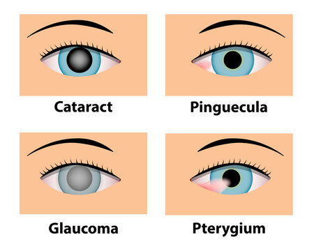 Cataract, Pinguecula, Glaucoma and Pterygium, eye care