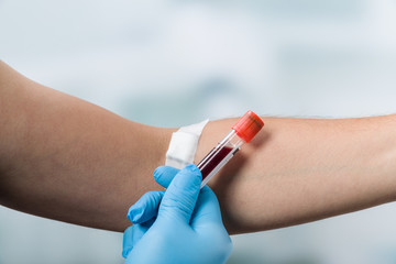 Hand mit Handschuh hält Blutprobe vor einem Arm mit Pflaster
