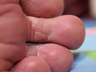 athlete's foot