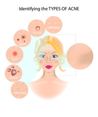 Identifying the TYPES OF ACNE.