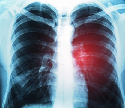 X-ray of human chest, closeup