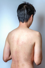 Man with dermatitis problem of rash, Allergy rash
