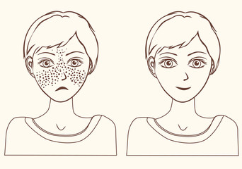 Concept for girl remove freckles outline.