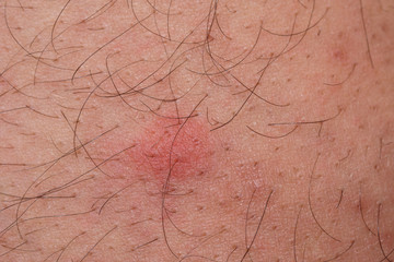 closeup of flea bite, macro