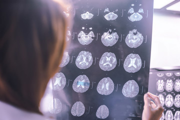 stroke on MRI file multiple small hemorrhagic