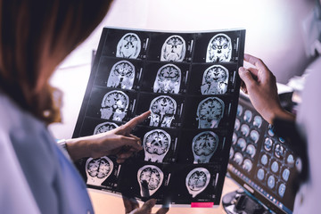 brain atrophy on MRI of Dementia patient - obrazy, fototapety, plakaty