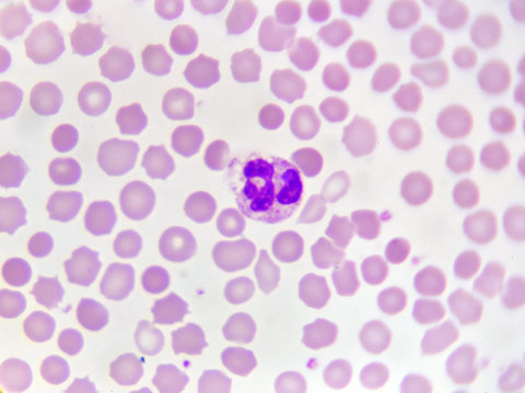Neutrophil cell (white blood cell) in blood smear, analyze by microscope
