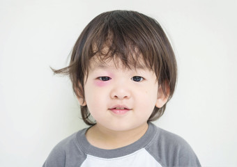 Closeup swollen eye of kid from insect bite with red bruise but he can smile
