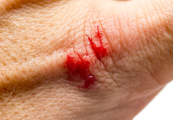 Blood on the skin from a cut with a knife