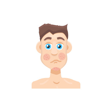 Psoriasis Or Rosacea Men Face. Vector Illustration.