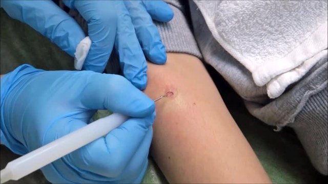 Dermatologist surgeon removes scar skin in arm with electrocoagulation