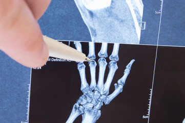 X-ray scan of hand, bones and finger joints. Doctor pointed on finger small joints, where pathology...