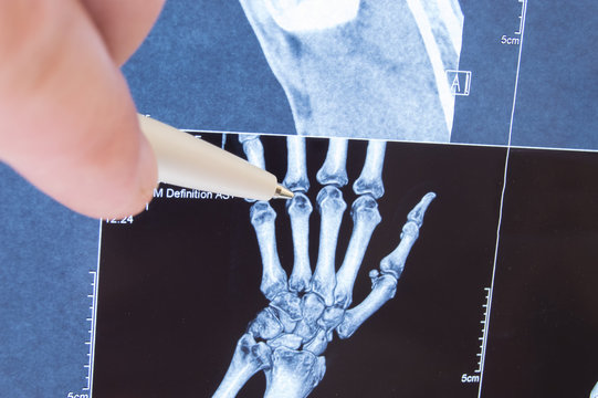 X-ray scan of hand, bones and finger joints. Doctor pointed on finger small joints, where pathology is detected, such as arthritis, rheumatoid,fracture. Diagnosis of joint diseases by radiology 