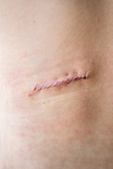 stitched up scar on back agter surgery