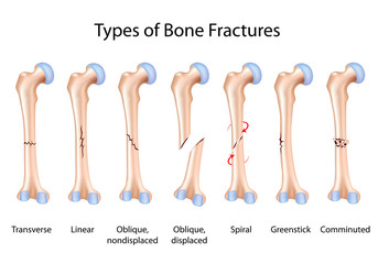 Types of bone fractures