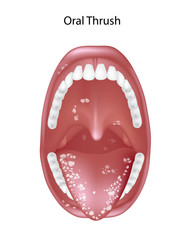 Oral thrush, candidiasis