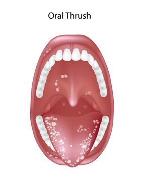 Oral thrush, candidiasis