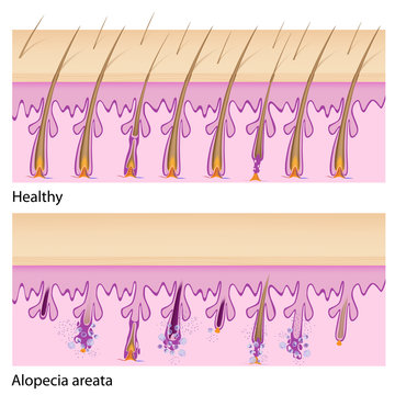 Normal Hair And Alopecia Areata