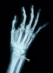 Human Left hand on device x ray.