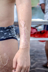 Scars after a burn